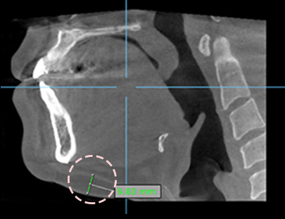3D CT FIT 얼굴지방흡입
