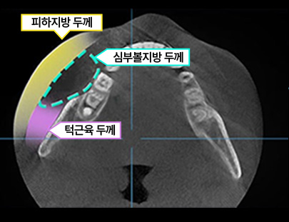 3D CT FIT 얼굴지방흡입