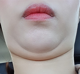 3D CT FIT 얼굴지방흡입