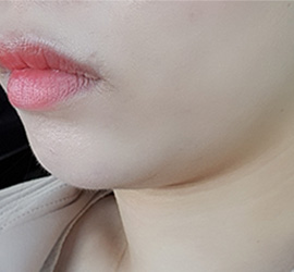 3D CT FIT 얼굴지방흡입