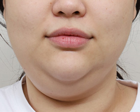 3D CT FIT 얼굴지방흡입