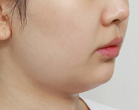 3D CT FIT 얼굴지방흡입