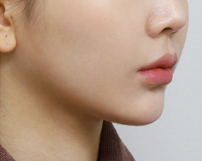 3D CT FIT 얼굴지방흡입