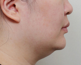 3D CT FIT 얼굴지방흡입