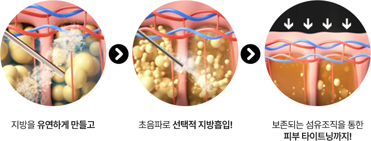 3D CT FIT 얼굴지방흡입