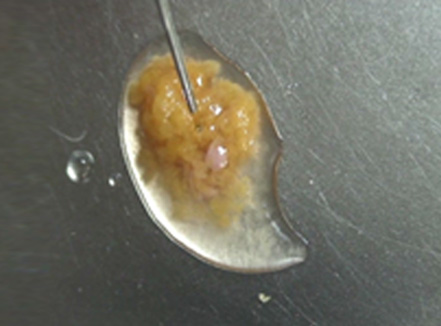 3D CT FIT 얼굴지방흡입