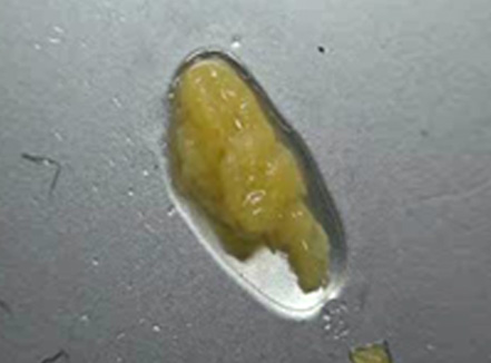 3D CT FIT 얼굴지방흡입