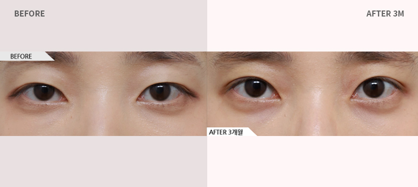 에이탑성형외과 핏미눈성형+눈매교정 전후사진