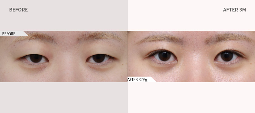 에이탑성형외과 핏미눈성형+눈매교정+윗트임 전후사진