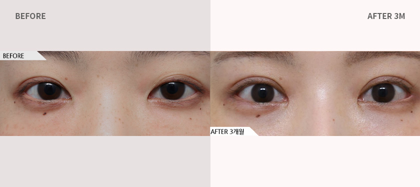 에이탑성형외과 핏미눈성형+윗트임+앞트임 전후사진