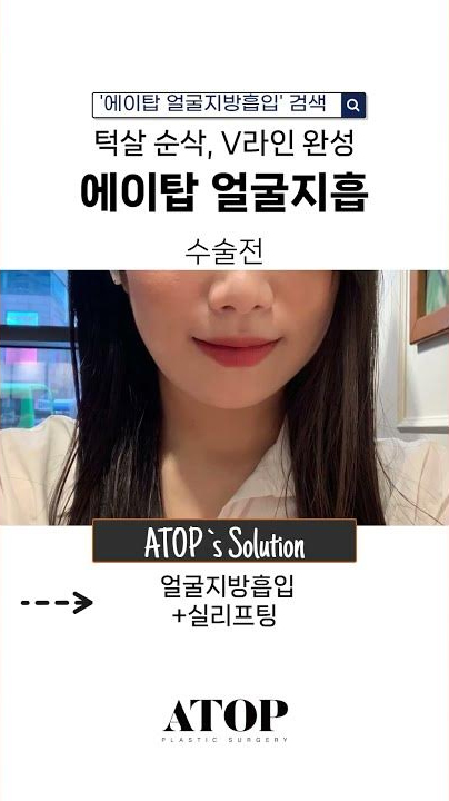 턱살 순삭, V라인 완성 에이탑성형외과 얼굴지흡 BEFORE&AFTER