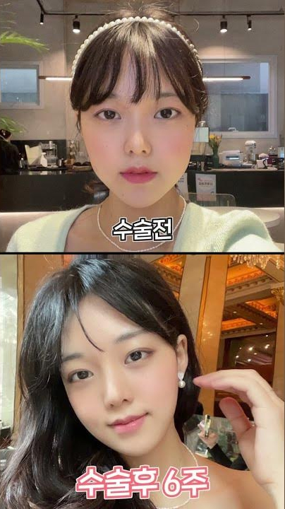 오똑하게 에이탑성형외과 코성형+여우윤곽술+눈밑지방+이마지방이식