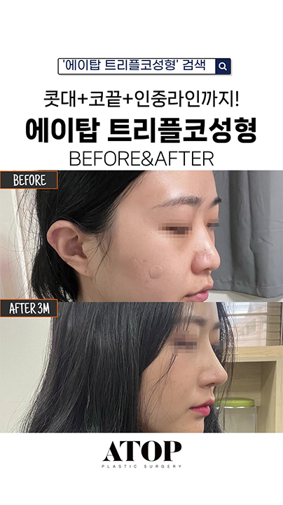 콧대+코끝+인중라인까지! 에이탑성형외과 트리플 코성형