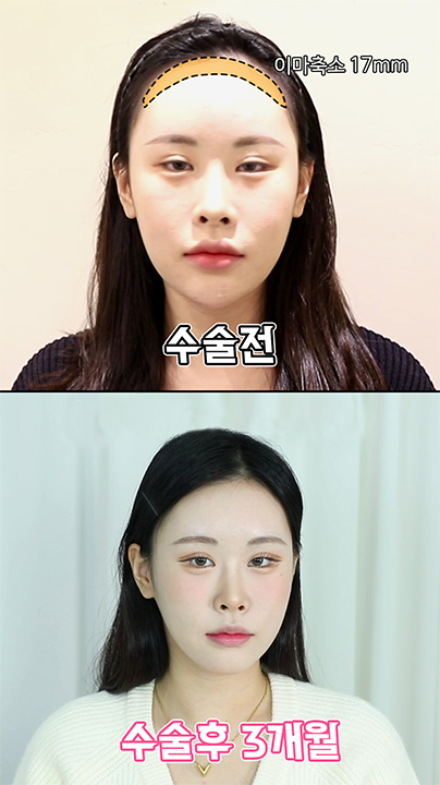 두피는 내리고 이마는 끌어 올려! 에이탑성형외과 이마성형, 이마축소
