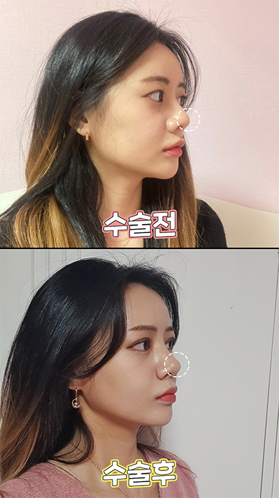 좀 더 화려한 모양으로! 에이탑성형외과 눈코성형