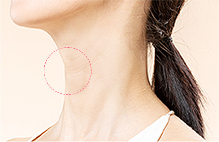A-Top Plastic Surgery Neck Wrinkles for People in Their 30s–50s by Age Group