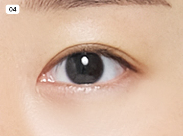 에이탑성형외과 핏미 자연유착 수술방법 이미지