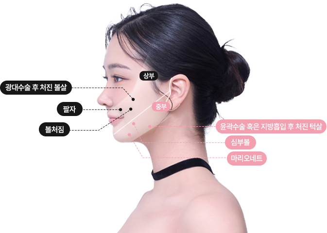 에이탑성형외과 심술보리프팅 시술부위 이미지