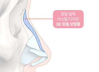 에이탑성형외과 3D 맞춤 보형물 기술력 3D 맞춤 보형물
