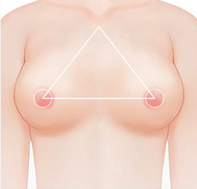 A-Top Plastic Surgery Breast Revision Surgery: Asymmetry / Shape Deformity
