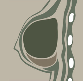 A-Top Plastic Surgery Breast Revision Surgery Upper Bulge