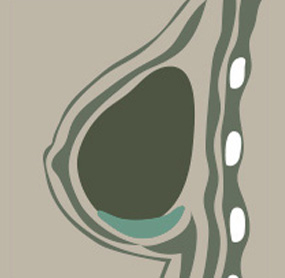 A-Top Plastic Surgery Breast Revision Surgery Upper Bulge