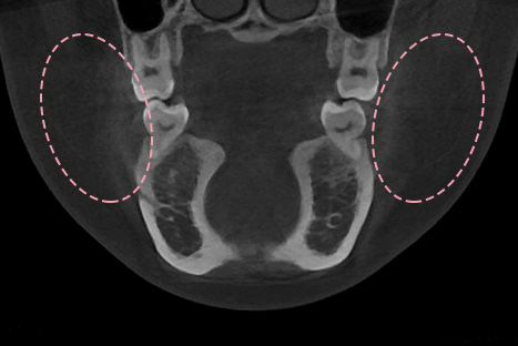 A-Top Plastic Surgery Deep Cheek Fat Repositioning/Removal: Identifying the Precise Location of the Deep Cheeks