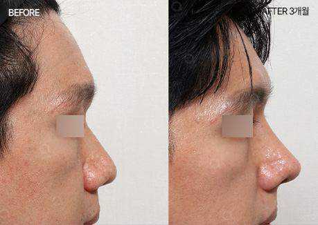 에이탑성형외과 남자 기능코성형 보험적용 코 질환 비밸브 협착증