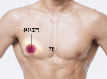 에이탑성형외과 남자 여유증 근육형