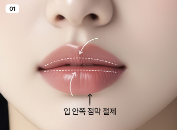 에이탑성형외과 입술축소술 입 안쪽 점막 절제