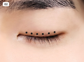 A-Top Plastic Surgery Male Eyelid Correction Inward Correction