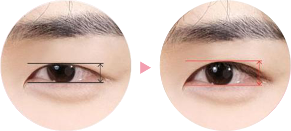A-Top Plastic Surgery's male eyelid correction technology and pupil exposure