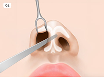 A-Top Plastic Surgery Noscar Non-incisional Rhinoplasty Delicate Dissection