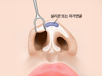A-Top Plastic Surgery Noscar Non-incisional Rhinoplasty Nose Line Correction