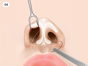 A-Top Plastic Surgery Noscar Non-incisional Rhinoplasty Delicate Suturing