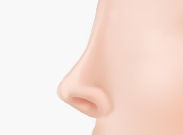 에이탑성형외과 코끝성형 코끝이 위로 들린 경우