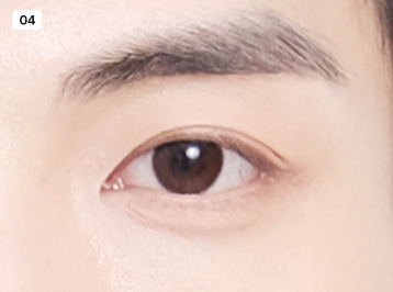 에이탑성형외과 남자 눈성형 슬림라인 눈성형 수술방법
