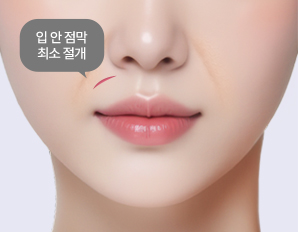A-Top Plastic Surgery Noble Surgery Noble Surgery Process Minimal Incision Inside the Mouth