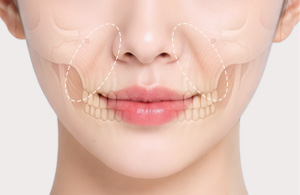A-Top Plastic Surgery Noble Surgery Structural Depression