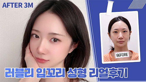 ATOP 입꼬리+입술 필러 리얼후기