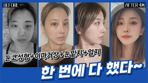 리얼후기 영상 (눈코성형+이마거상+눈밑지+얼지)
