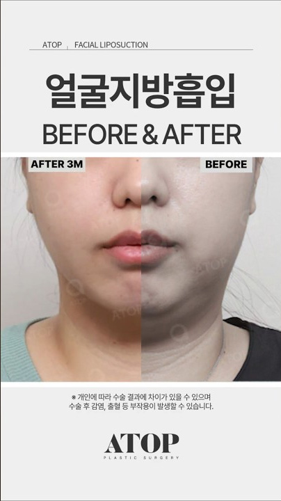 얼굴지방흡입 3개월차 진짜 변화 | Before After