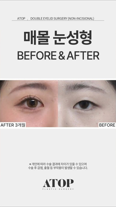 지금 당장 눈성형 하고 싶은 사람만 보세요🔥✨