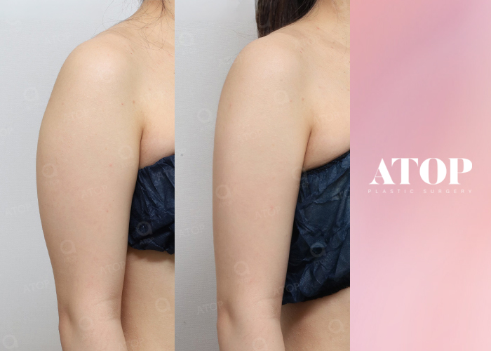 คอลัมน์ทางการแพทย์_04 การดูดไขมัน - ศัลยกรรมตกแต่ง A-Top