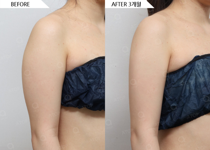 68457-팔LIPO 부유방LIPO-w - 에이탑성형외과