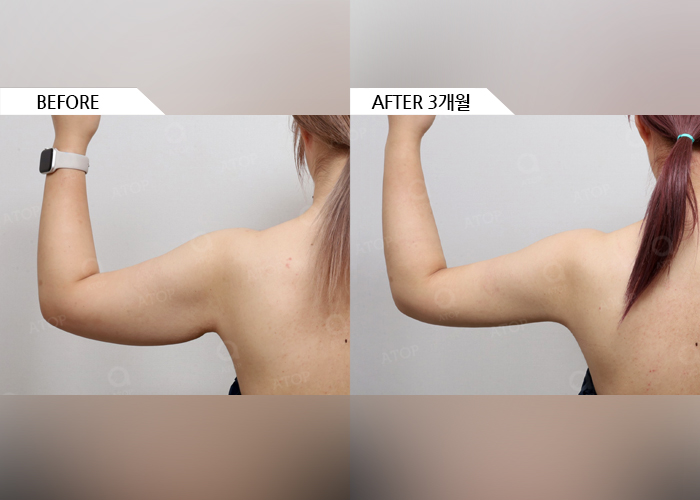 70407-팔LIPO 1-w - 에이탑성형외과