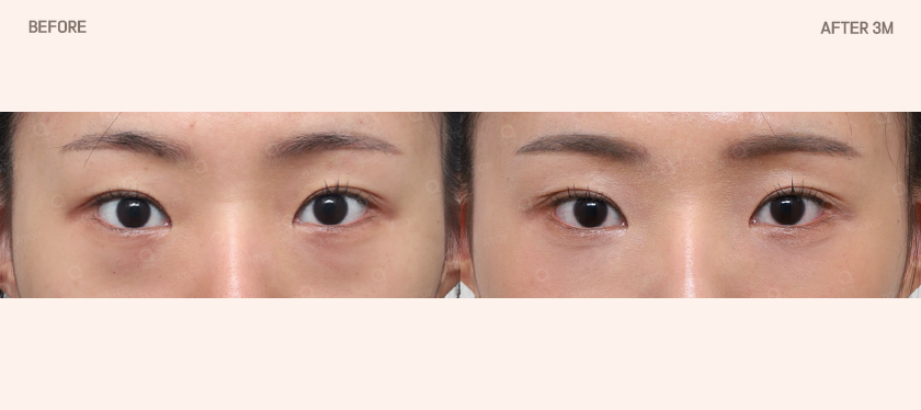 75187-TCFR 아이리쥬란 - 에이탑성형외과